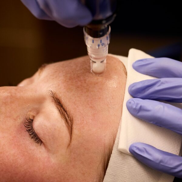 Microneedling