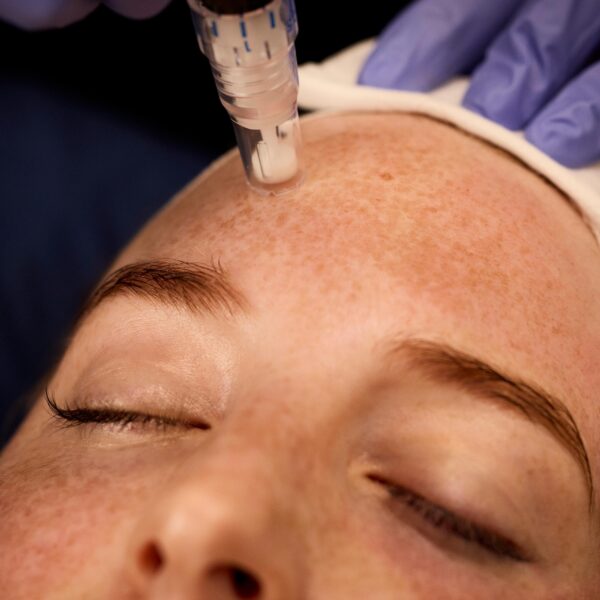 SkinPen Consultation