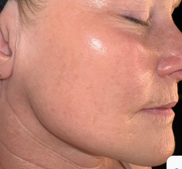 After Microneedling
