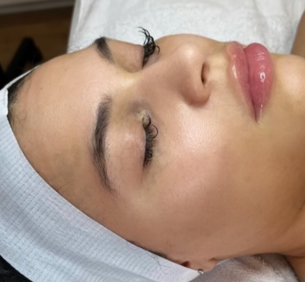 After Microneedling