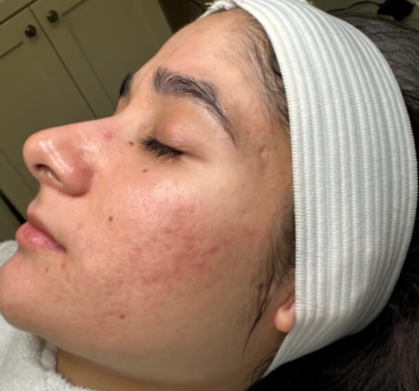 After Microneedling
