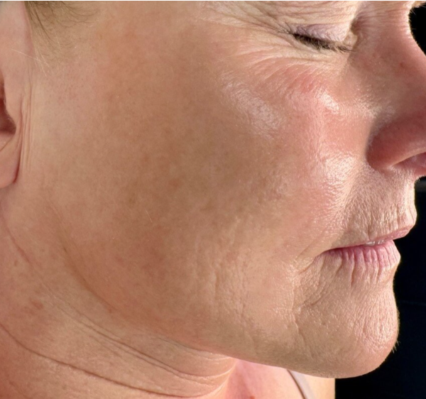 Before MicroNeedling
