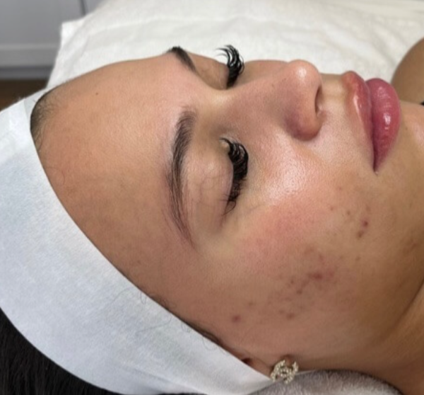 Before MicroNeedling