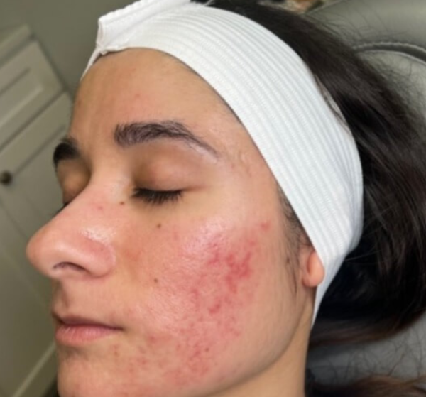 Before MicroNeedling